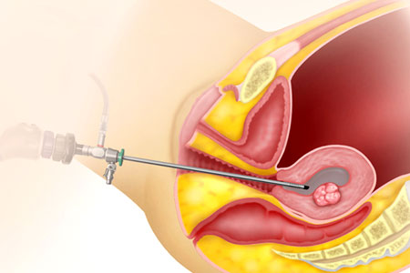 Hysteroscopy