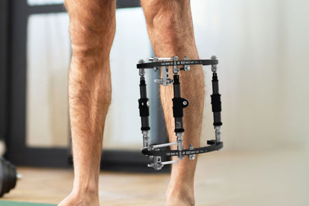 Deformity & Non-Union Management by Ilizarov Technique