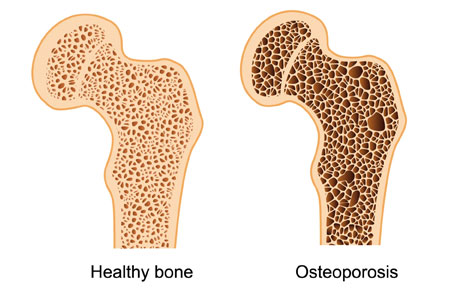 Osteoporosis Management