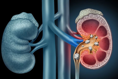Endourology & Stone Management
